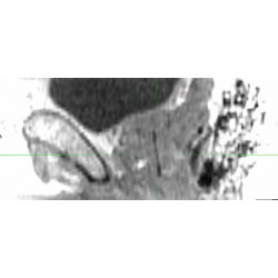 Fleximarc G/T MRI